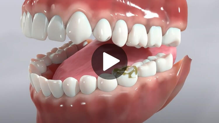 Thumbnail image for an education video on cavities