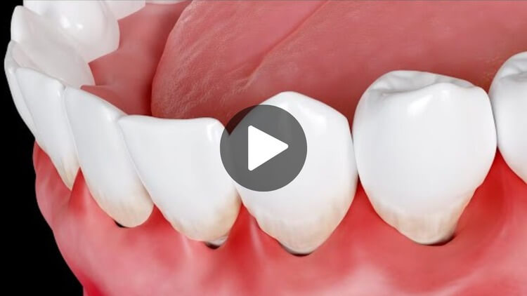 Thumbnail image for an education video on swollen gums